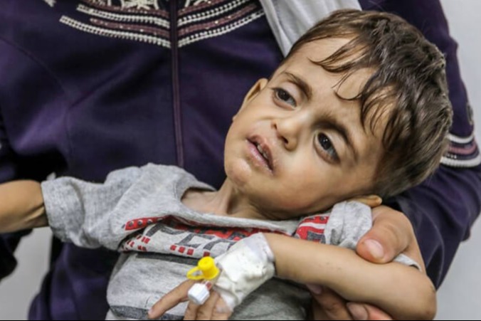 مرضى السرطان في غزة يواجهون مصيرًا مجهولًا وسط انهيار منظومة العلاج