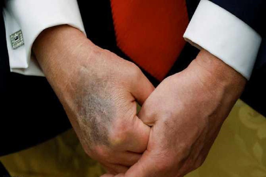 بعد إخفائه كدمات بمساحيق التجميل.. تساؤلات حول صحة ترامب
