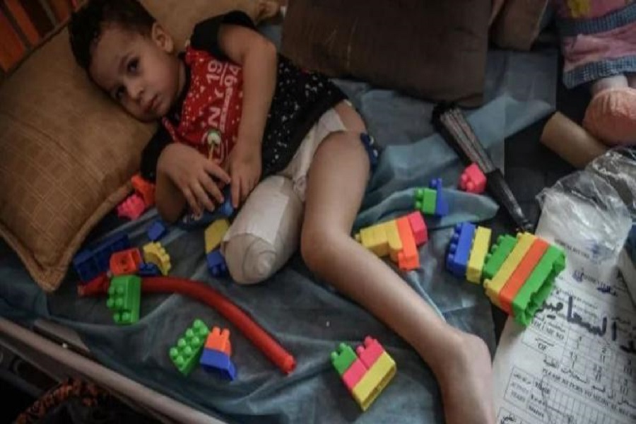 الصحة العالمية: أكثر من 15 ألف فلسطيني بُترت أطرافهم جراء الحرب على غزة