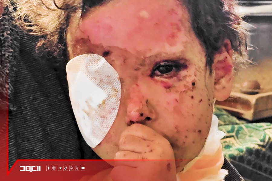 1500 مواطن في غزة يفقدون نعمة البصر .. بينهم أطفال