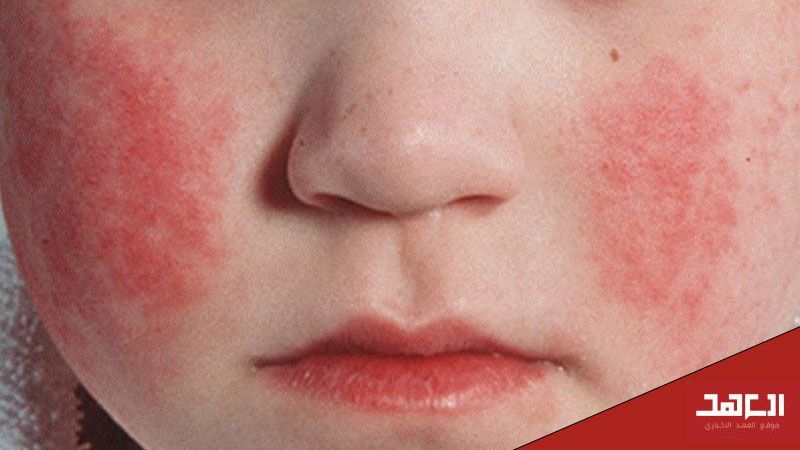"Parvovirus B19" يُربك المدارس.. والبزري لـ "العهد": ليس خطيرًا والمطلوب العلاج والوقاية